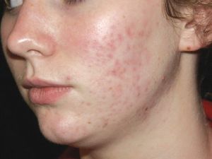 Agera-peel-for-Acne-after