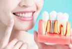 Преимущества имплантации зубов в современной стоматологии