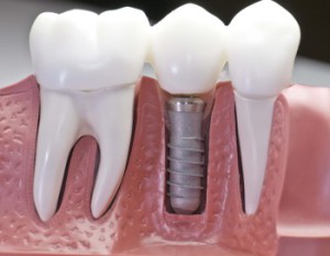  имплантация зубов