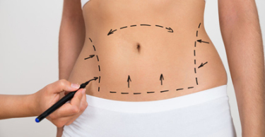 Показания в абдоминопластике