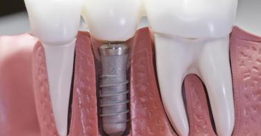 Зубные импланты