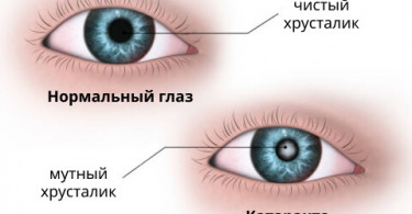 факоэмульсификация катаракты