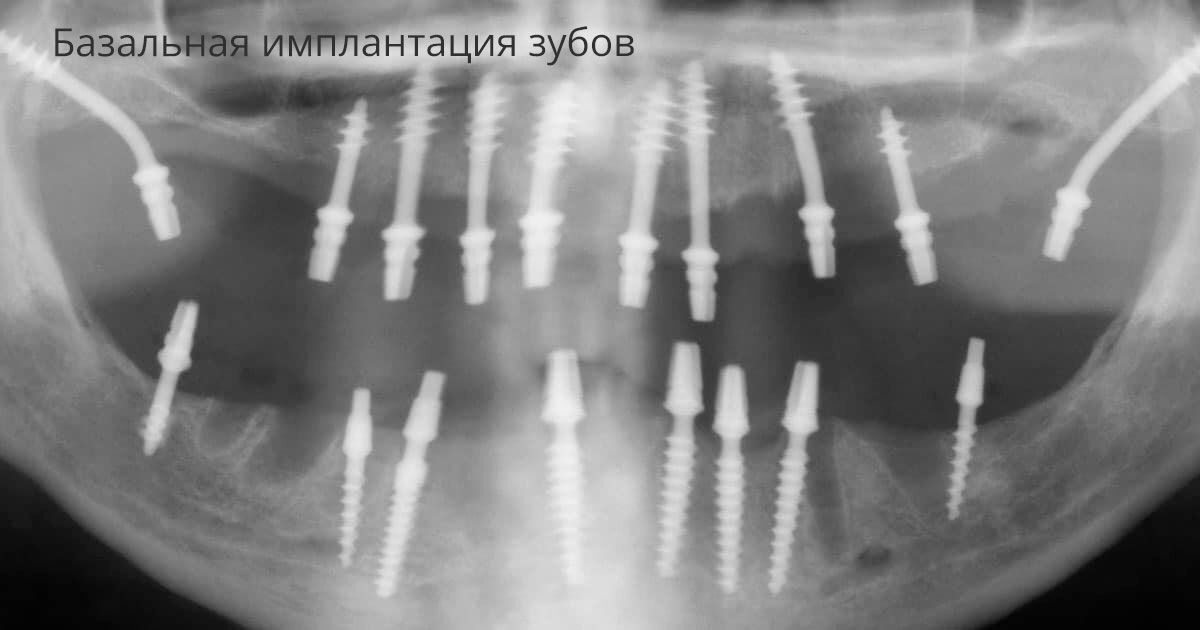Базальная имплантация верхней челюсти