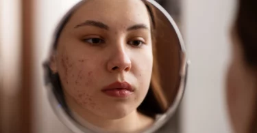 Девушка с акне смотрит на свое отражение в зеркале.