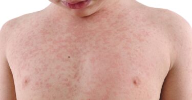 Коли у дитини з’являється висип