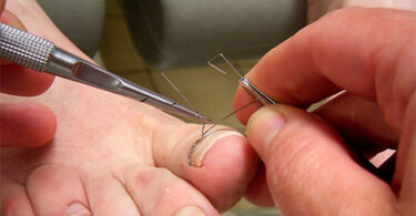 Коррекция ногтей скобами Фрезера