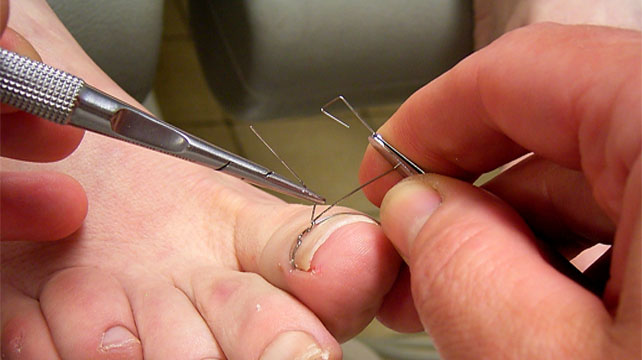 Коррекция ногтей скобами Фрезера